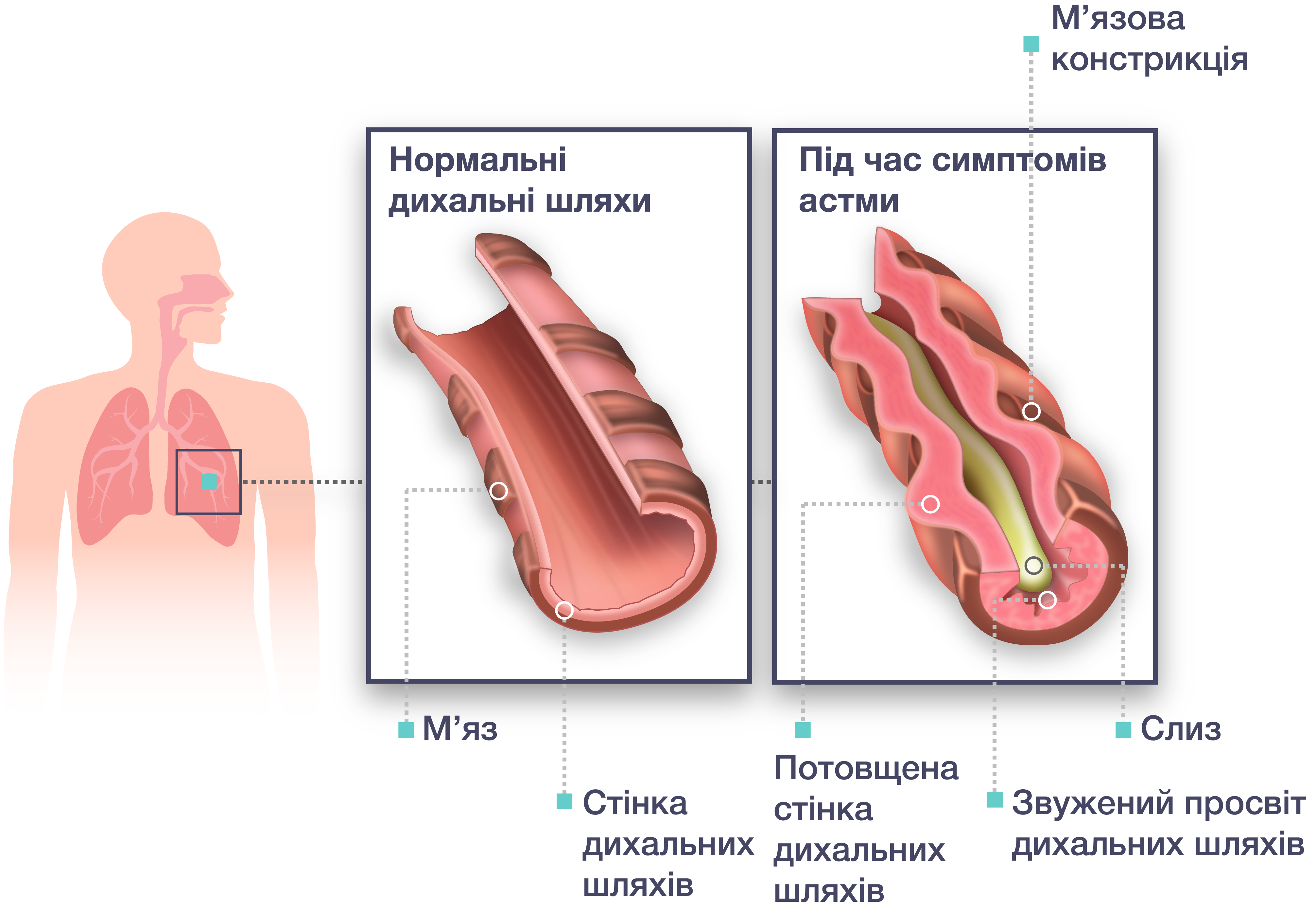 При кашле свист при выдохе