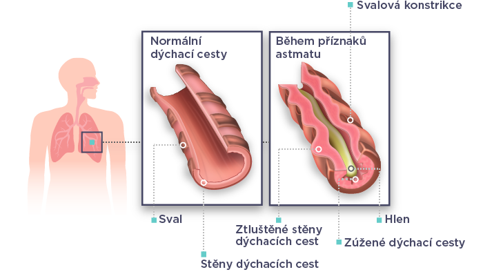 WehalePublic_asthma_figure_v01_20200115_CS.png