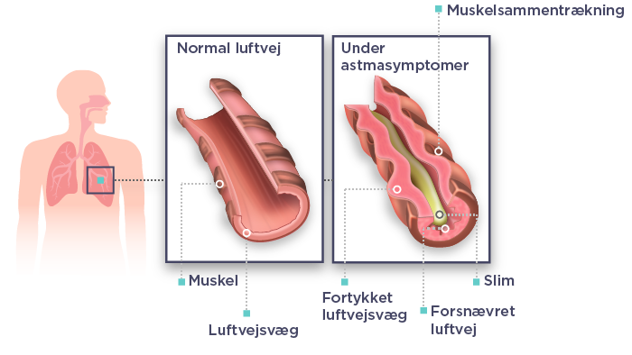 WehalePublic_asthma_figure_v01_20200115_DA_publish-01.png