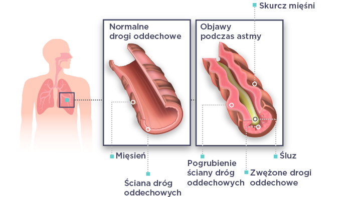 WehalePublic_asthma_figure_v01_20200115_PL.png