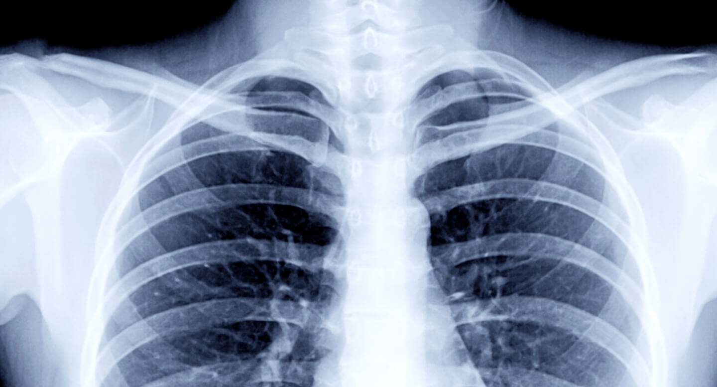 Miksi keuhkoahtaumatautiin sairastutaan?