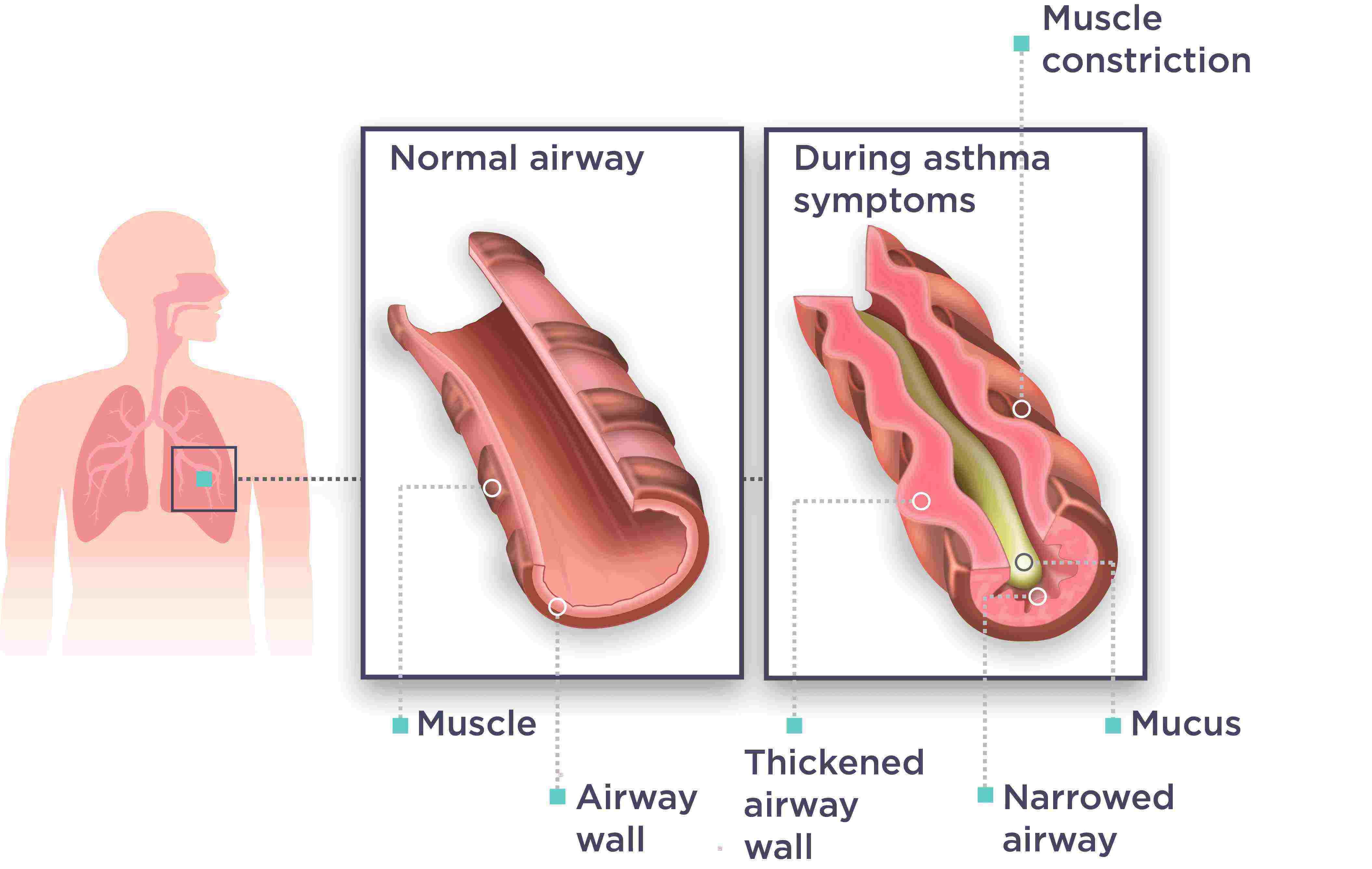 WehalePublic_asthma_figure_300ppi_v01_20200115.png