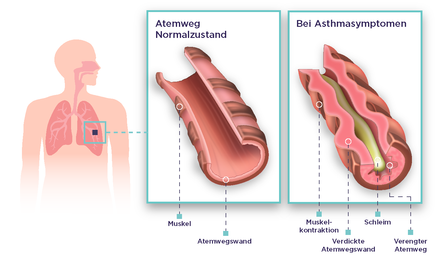 EH Grafik 1_Inflammation.png